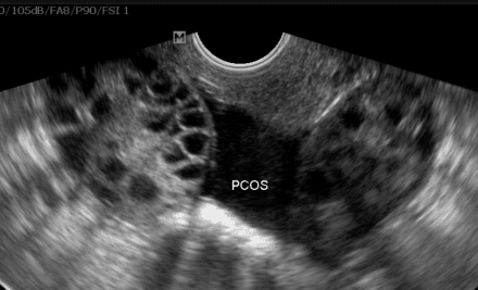 ultrasound ovary image of polycystic ovary syndrome