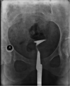 Bilat Prox occlusion