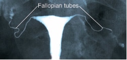 Figure 1: Hysterosalpingogram-Open fallopian tubes.